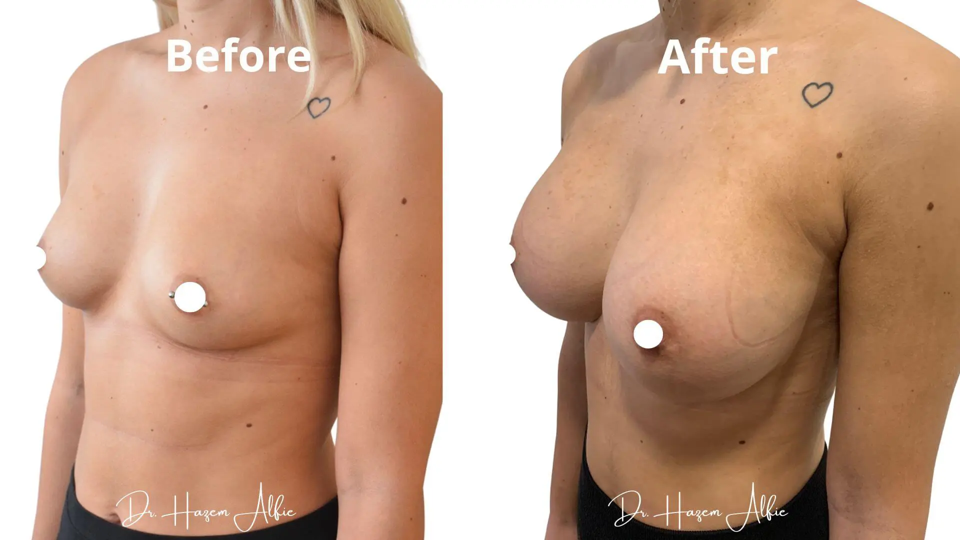 A woman before and after breast augmentation surgery.