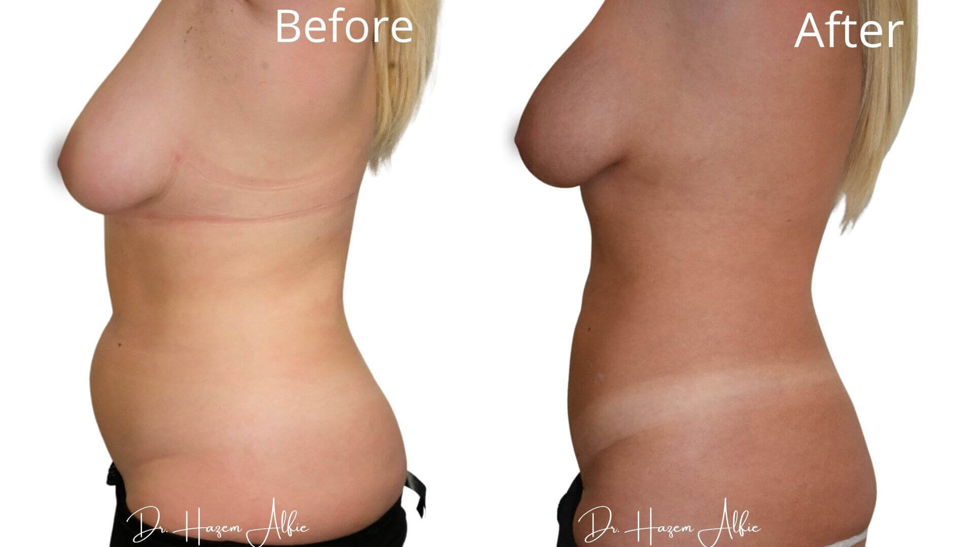 A before and after picture of the back of a woman 's body.