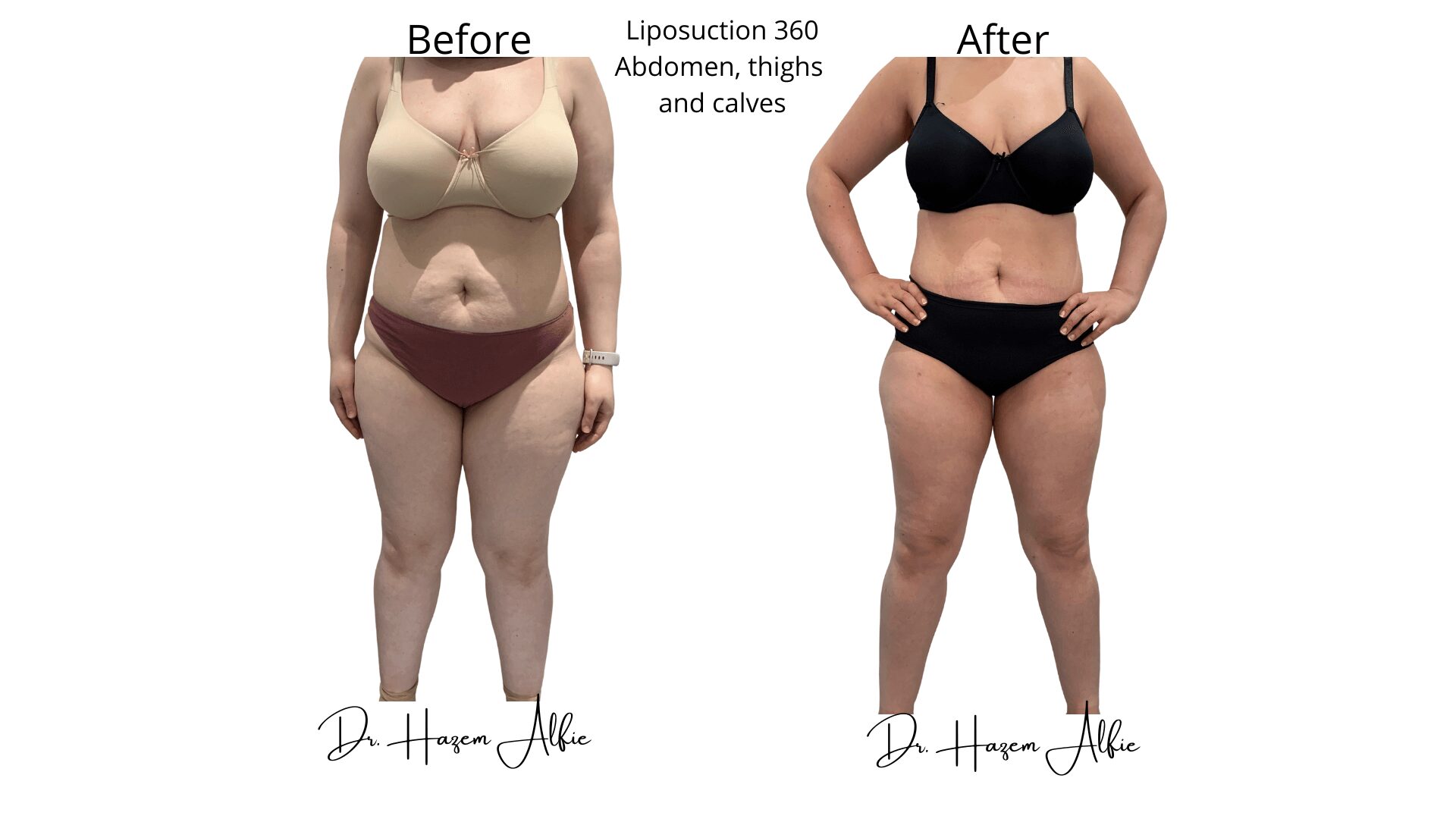 A woman before and after liposuction.