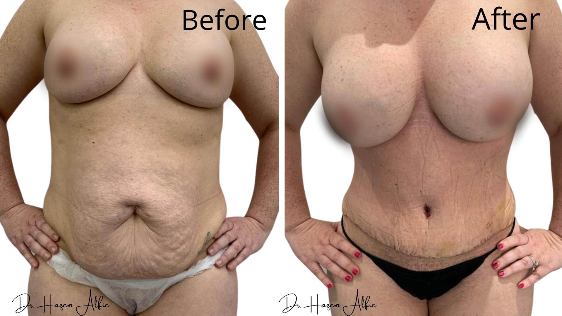 A woman's body before and after surgery.