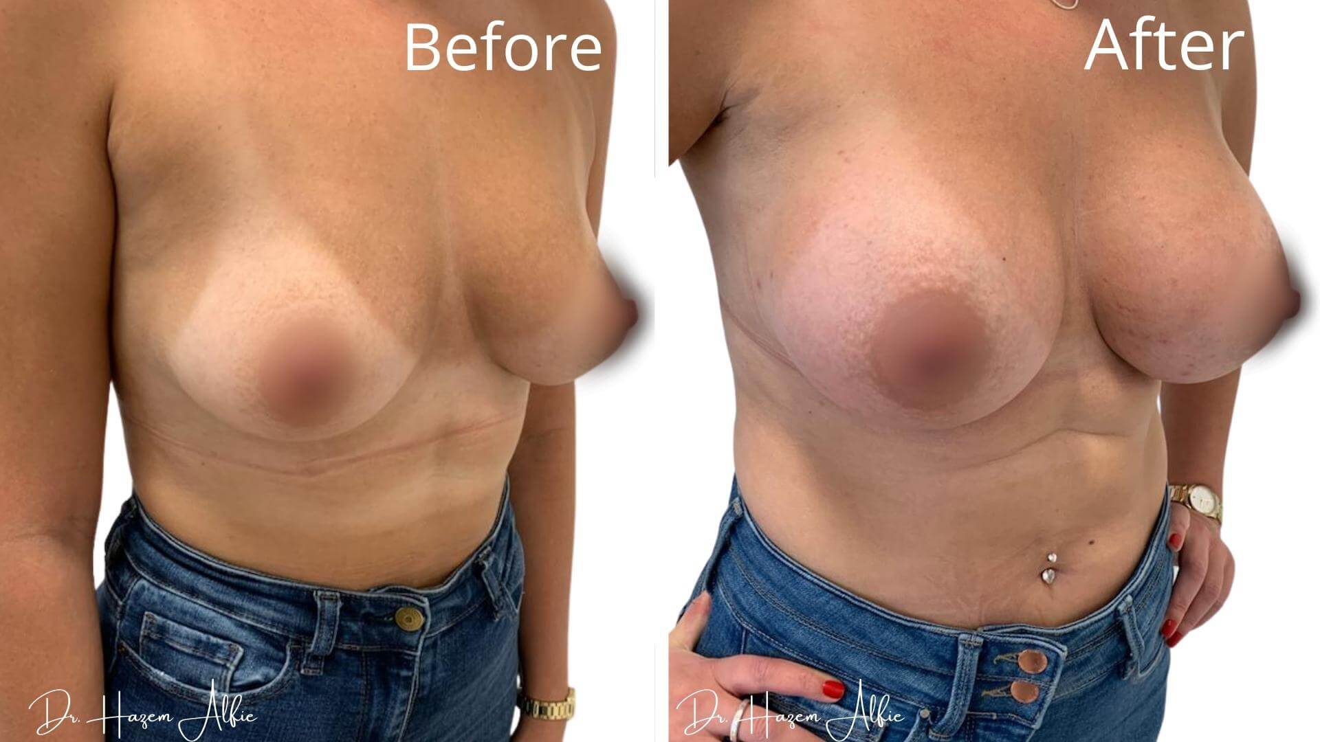 A woman with no bra and jeans before and after breast augmentation.