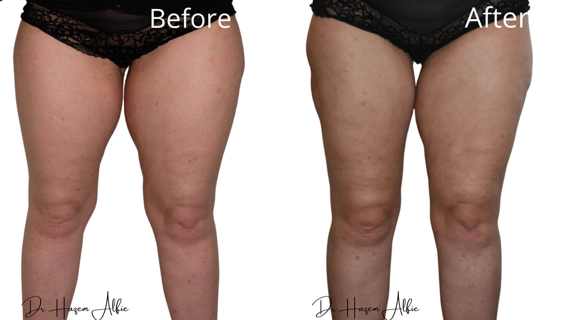 A before and after picture of the legs of two women.