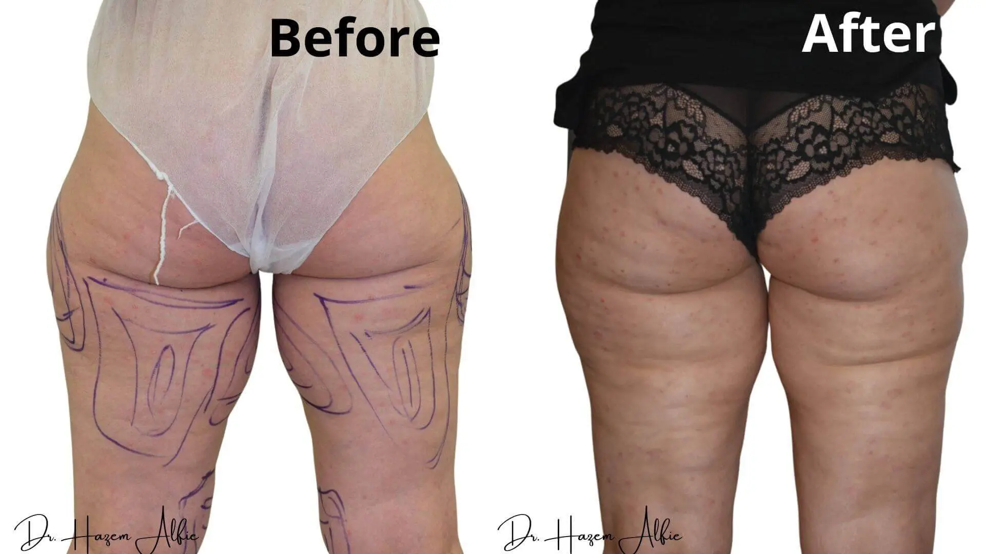 A woman 's legs before and after liposuction.