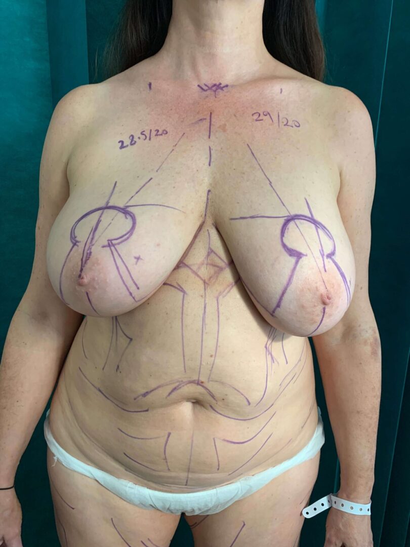 A woman with marks on her breast.