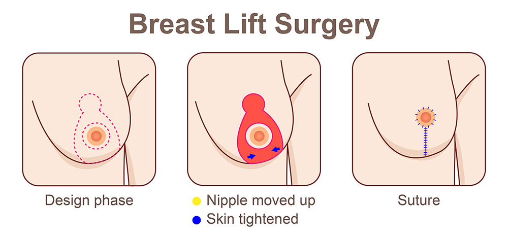 breast lift procedure, breast tissue, excess skin removal