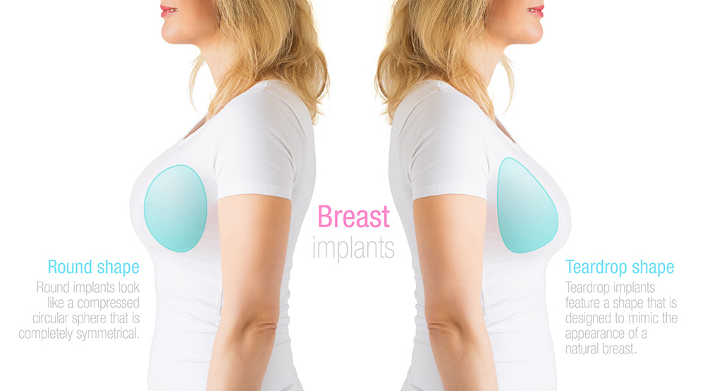 Breast implants, natural results, cosmetic breast augmentation surgery