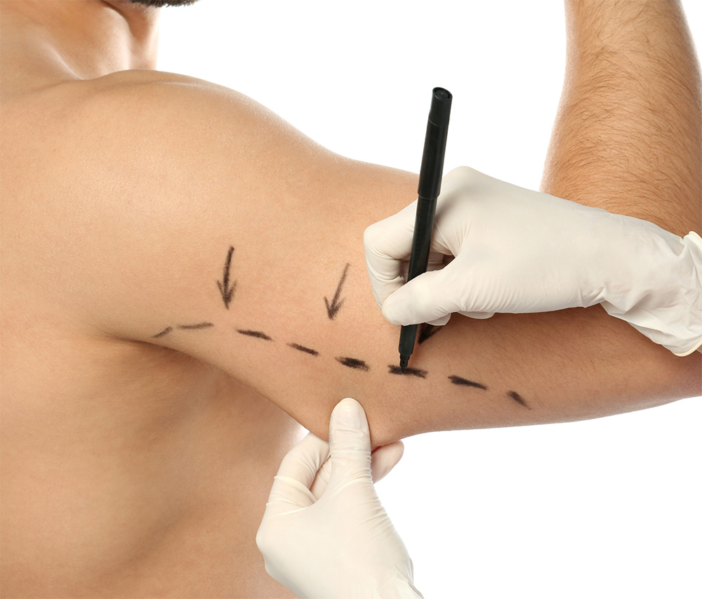 brachioplasty London, sagging skin on upper arms, arm contouring, loose skin