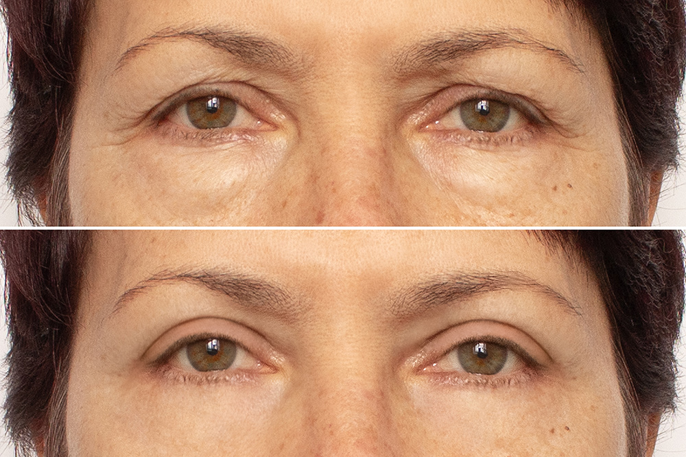 eyelid surgery London, puffy eyes, eye rejuvenation