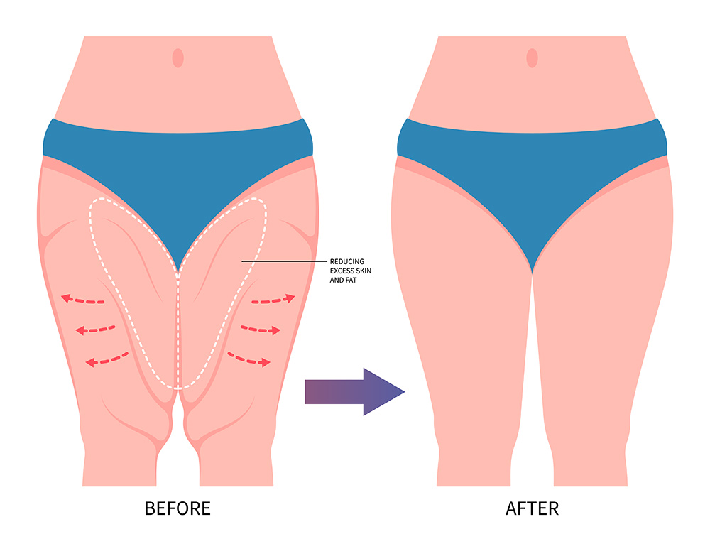 post weight loss surgery, thigh lift surgery London, upper leg contouring