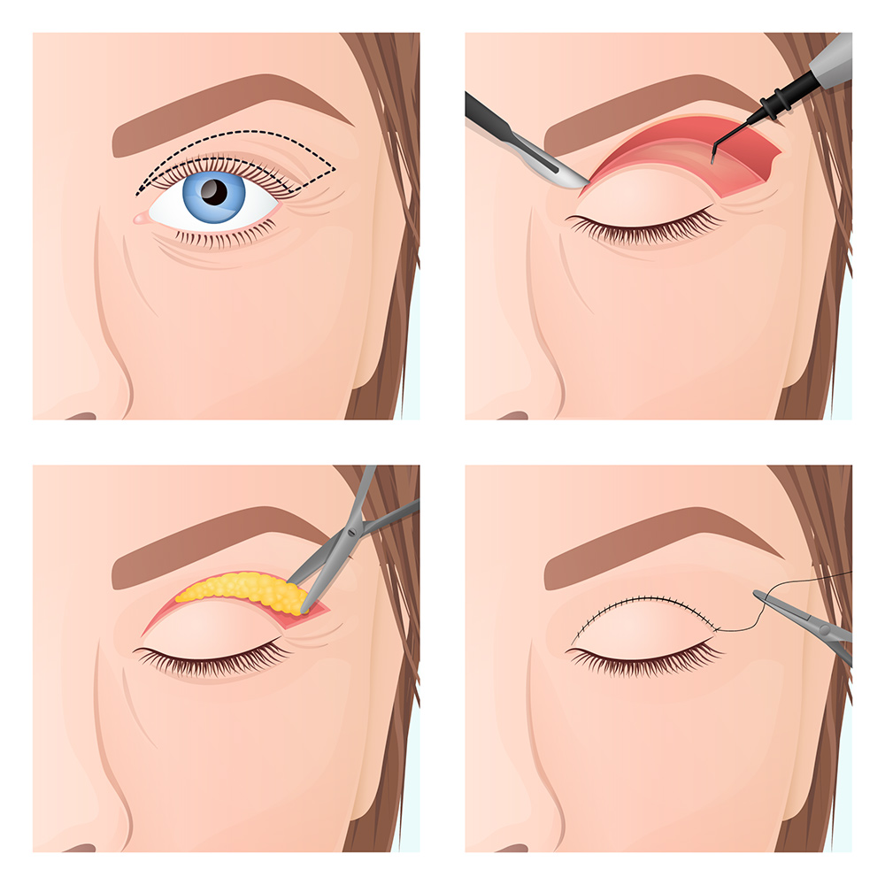 eyelid surgery London, sagging upper eyelids, loose eyelid skin