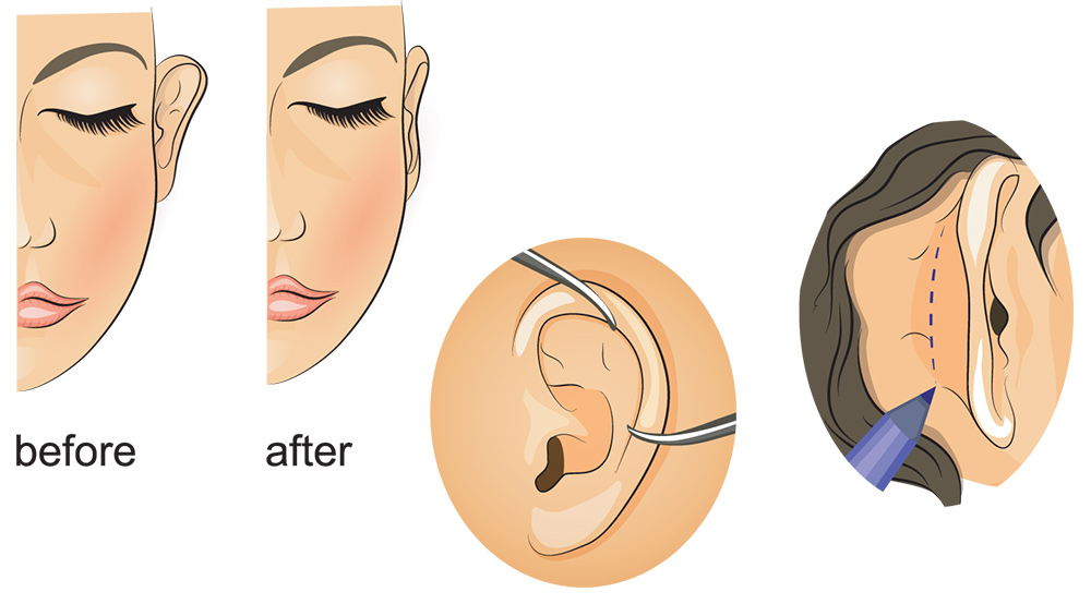 ear pinning surgery London, protruding ears, balanced ear shape