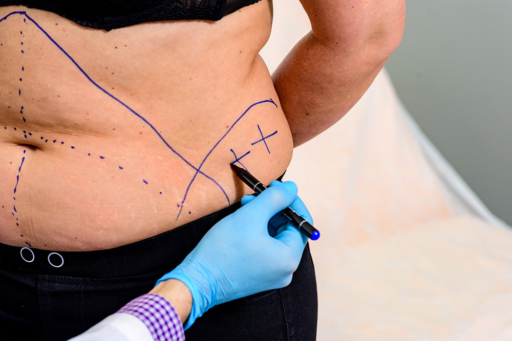 tummy tuck for high BMI, plus size abdominoplasty, body contouring for plus size