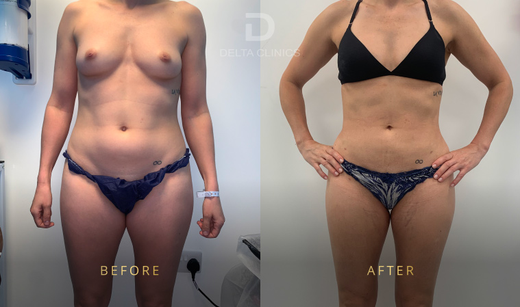 360 liposuction London, full body liposuction, sculpt abdomen and waist, balanced body contour