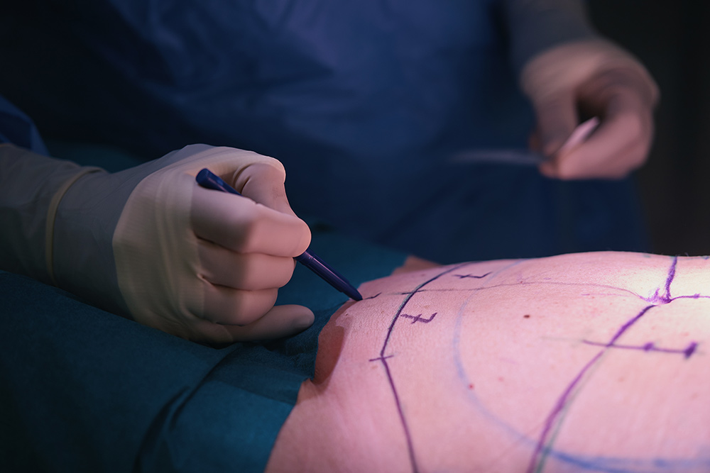 mini tummy tuck London, post pregnancy surgery, targeted abdominal contouring