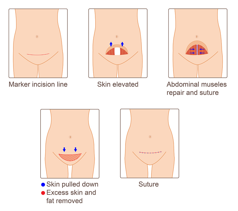 mini tummy tuck, remove loose skin, lower abdomen surgery