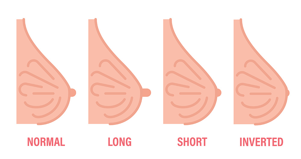 inverted nipple correction london, restore nipple projection, breast contour improvement