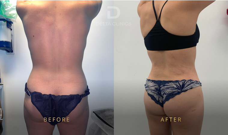 weight loss and liposuction, fat distribution vs fat removal, liposuction not weight loss