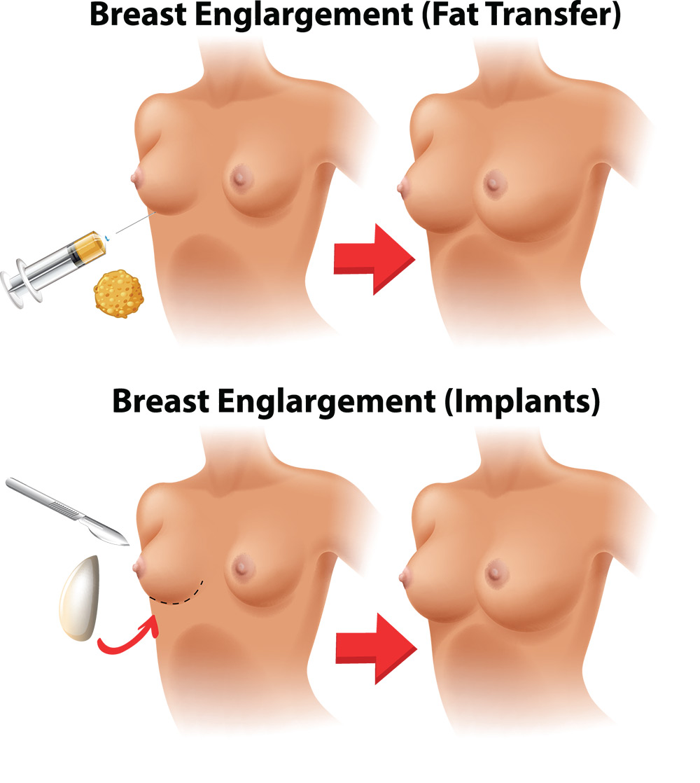 breast implants vs fat transfer, implant vs fat transfer suitability, breast augmentation anatomy considerations