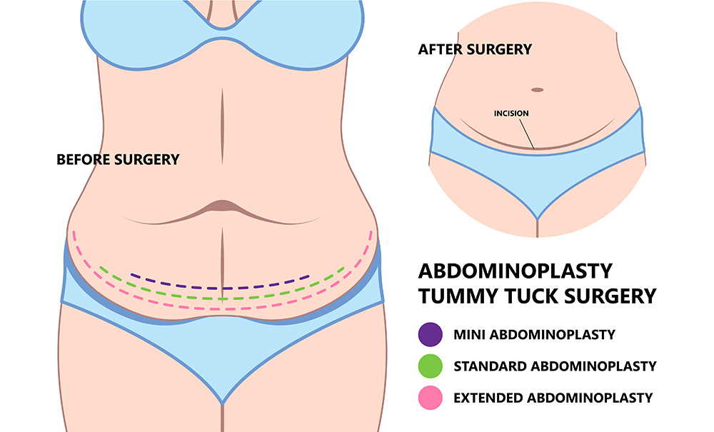 mini tummy tuck vs full tummy tuck, difference between mini and full tummy tuck, abdominal skin laxity, tummy tuck options