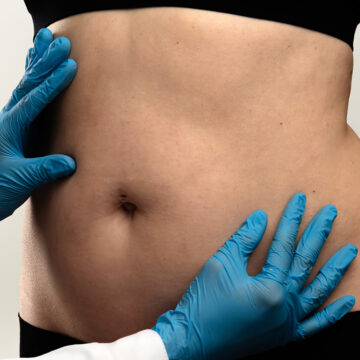 liposuction areas areas for liposuction body areas for liposuction common liposuction areas