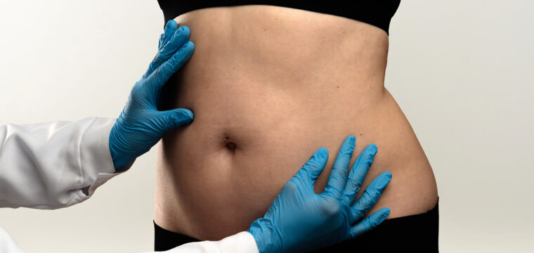 liposuction areas areas for liposuction body areas for liposuction common liposuction areas