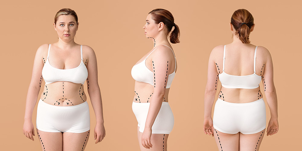 liposuction areas, multiple liposuction areas, body contouring procedure, fat removal areas