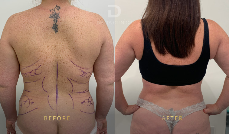 liposuction recovery timeline, how long does it take to recover from liposuction, liposuction recovery week by week