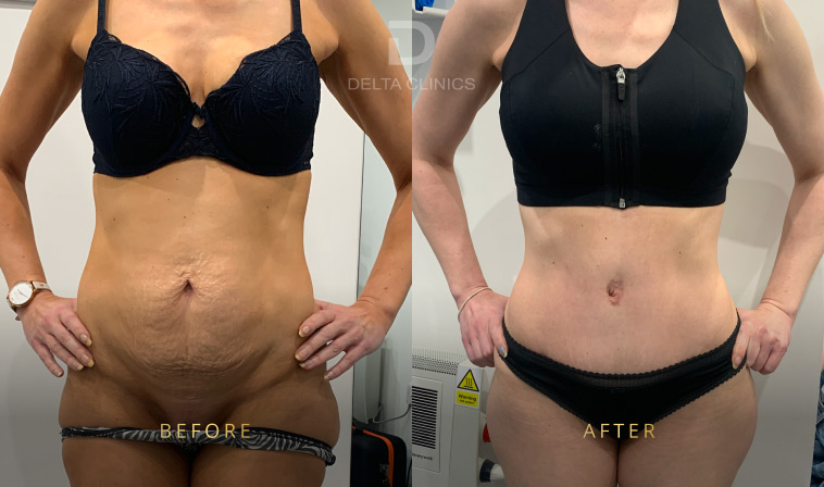 fleur-de-lis tummy tuck vs regular, abdominal skin laxity, tummy tuck comparison, surgical planning