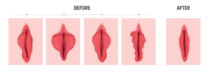 what is labiaplasty surgery, labia minora reshaping, labiaplasty procedure