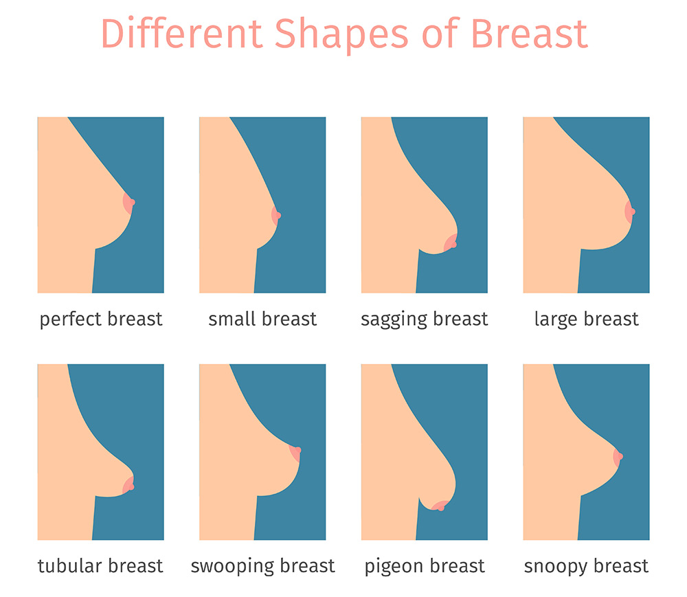 what are tubular breasts, tubular breast shape, enlarged areolae, lower breast fullness