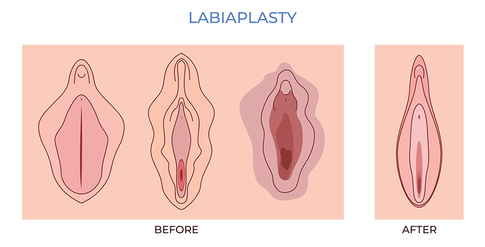 labiaplasty before and after, labia minora reshaping, labiaplasty surgery, realistic expectations
