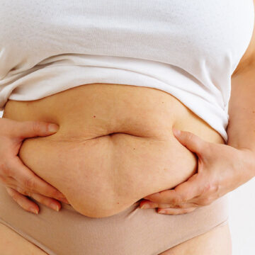how to get rid of apron belly, apron belly surgery, tummy tuck for apron belly, lower abdominal overhang