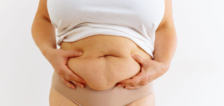how to get rid of apron belly, apron belly surgery, tummy tuck for apron belly, lower abdominal overhang