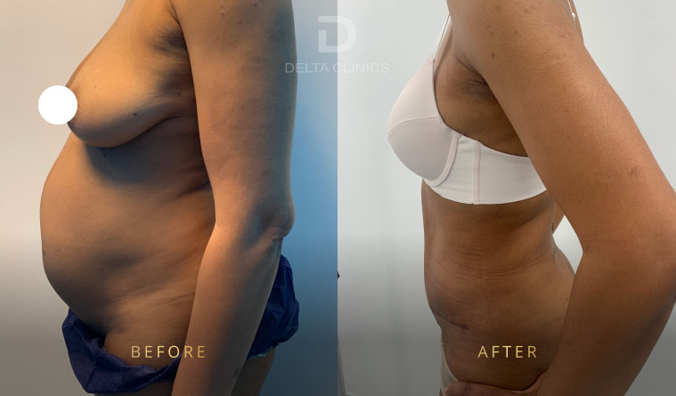 how to get rid of apron belly, apron belly, lower abdominal overhang, abdominal pannus, excess lower abdominal skin