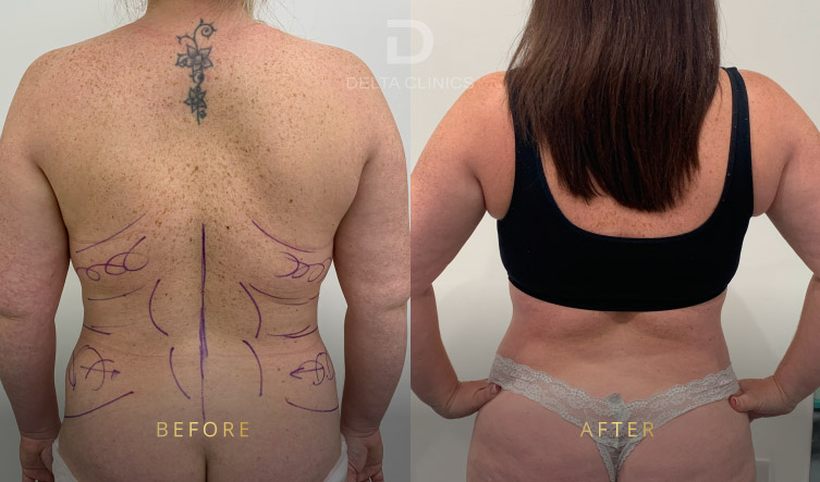 liposuction cost UK, VASER liposuction pricing, ultrasound technology, controlled fat removal